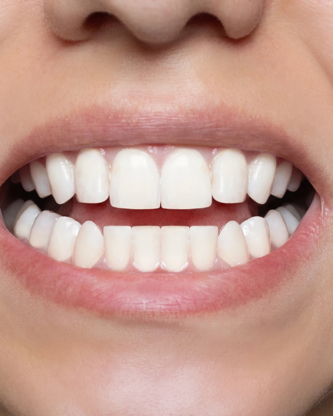 Teeth after whitening